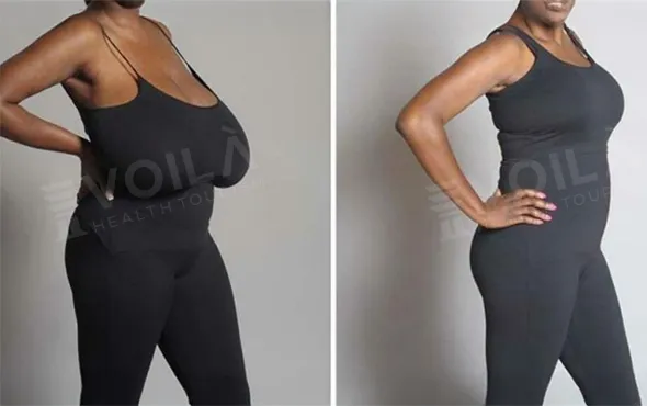 breast reduction - - Dr Furkan Certel - Voila Health Tourism