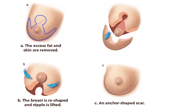 breast reduction - - Dr Furkan Certel - Voila Health Tourism