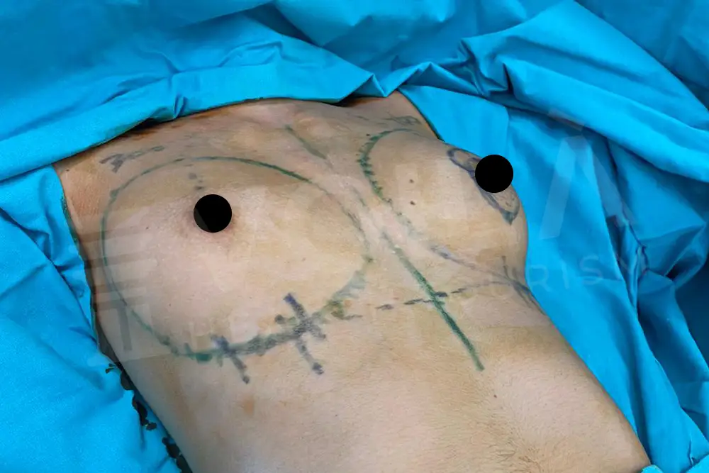 Breast Implant - Voila health tourism - dr furkan certel