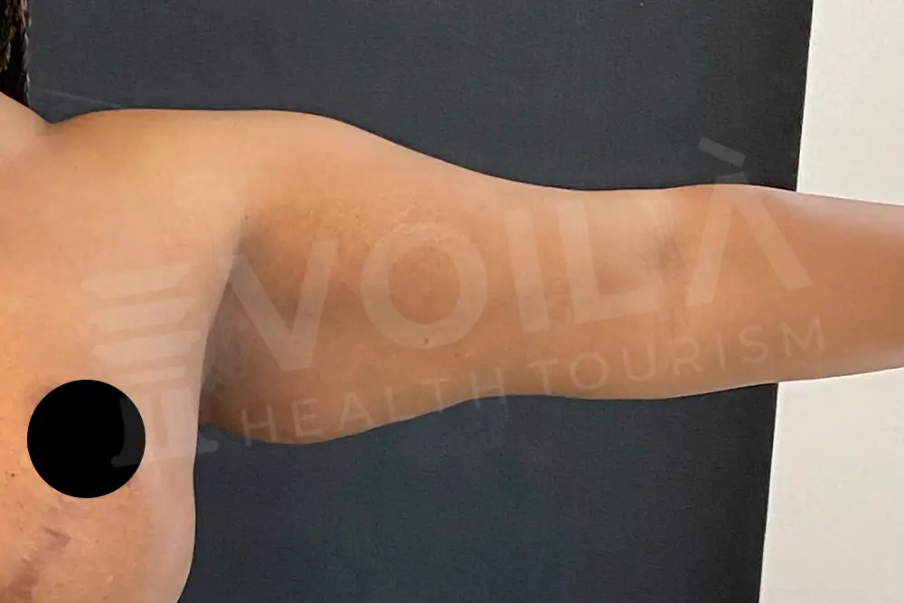 Arm Lift - Voila Health Tourism - Dr Furkan Certel