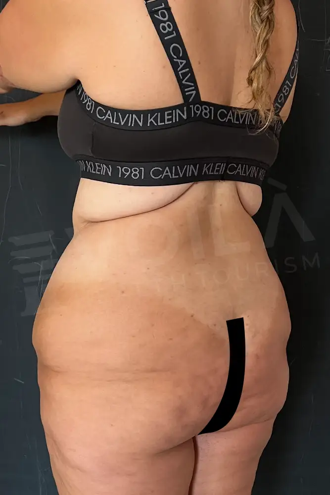 Back Lift - Voila Health Tourism - Dr Furkan Certel
