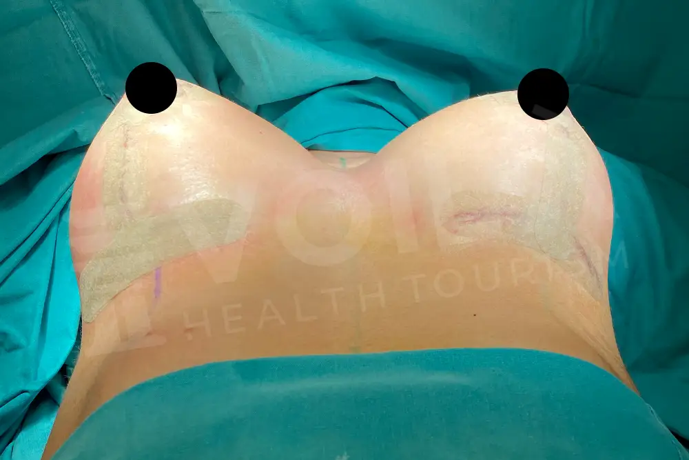 Breast Lift & Implant - Voila Health Tourism - Dr Furkan Certel