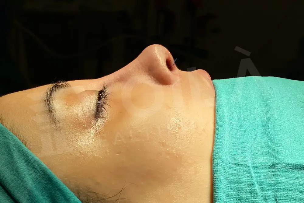 Rhinoplasty - - Voila Health Tourism - Dr Furkan Certel