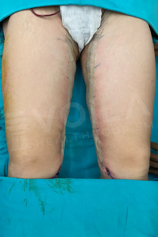 Thigh Lift -- Voila Health Tourism - Dr Furkan Certel