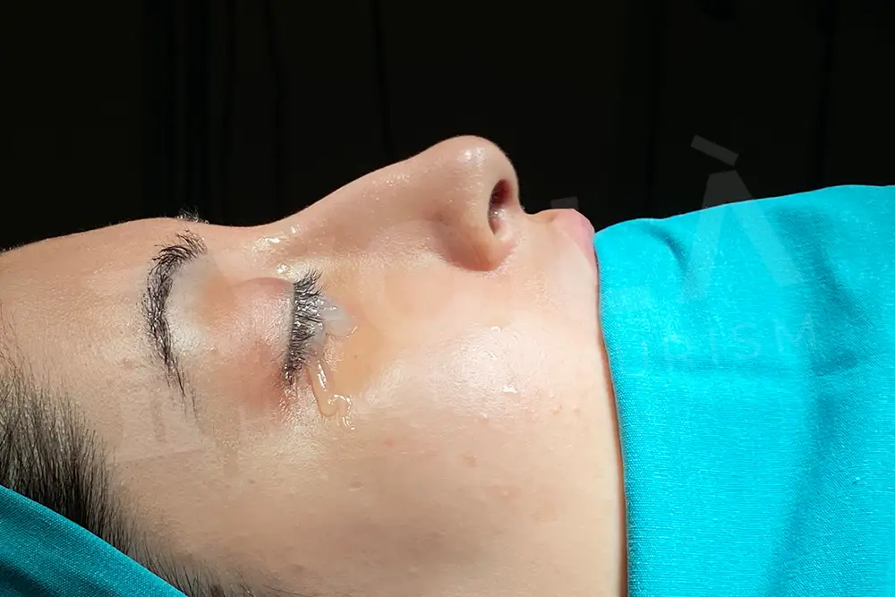 Rhinoplasty - - Voila Health Tourism - Dr Furkan Certel