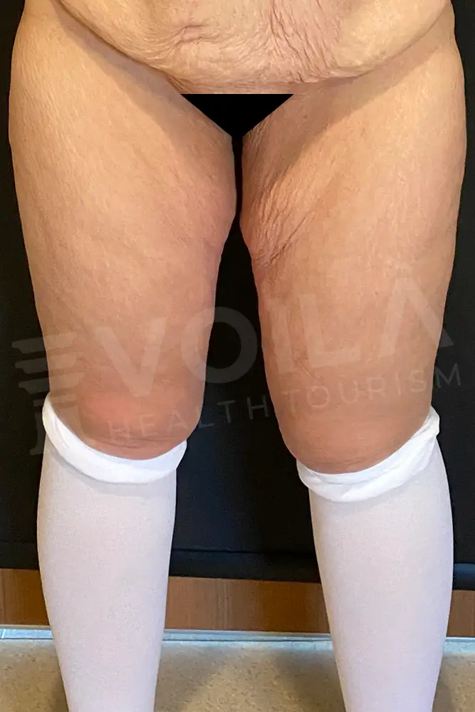 Thigh Lift -- Voila Health Tourism - Dr Furkan Certel