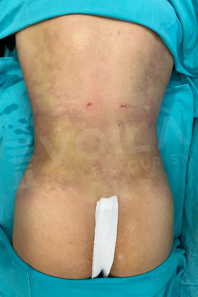 Liposuction - Voila health tourism - dr furkan certel