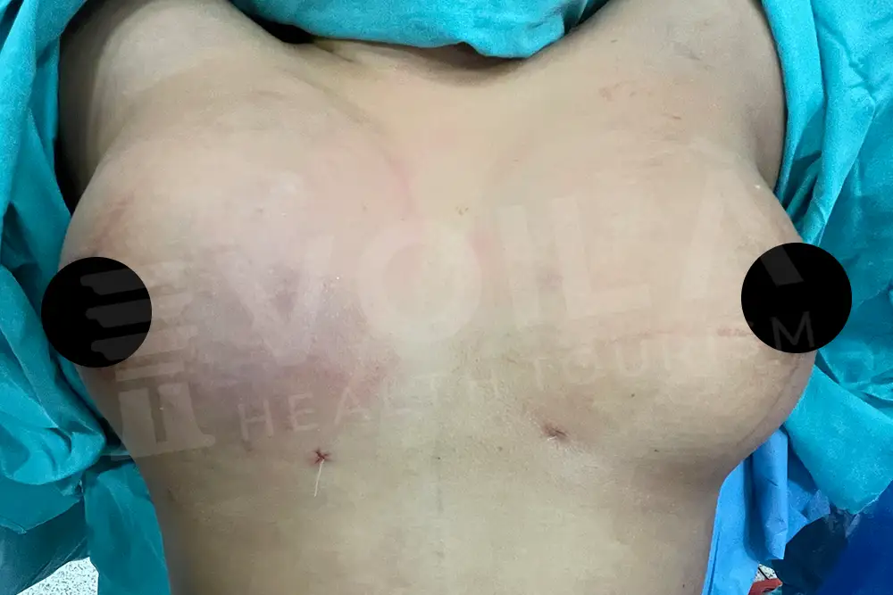 Breast Fat Injection - Voila Clinic - Dr Furkan Certel