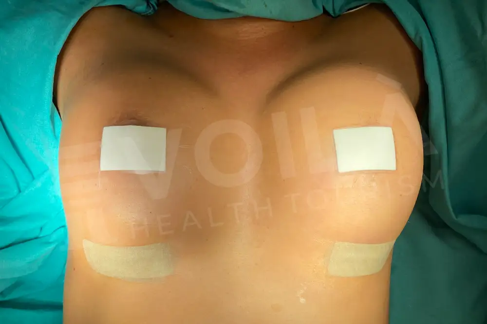 Breast Implant - Voila health tourism - dr furkan certel