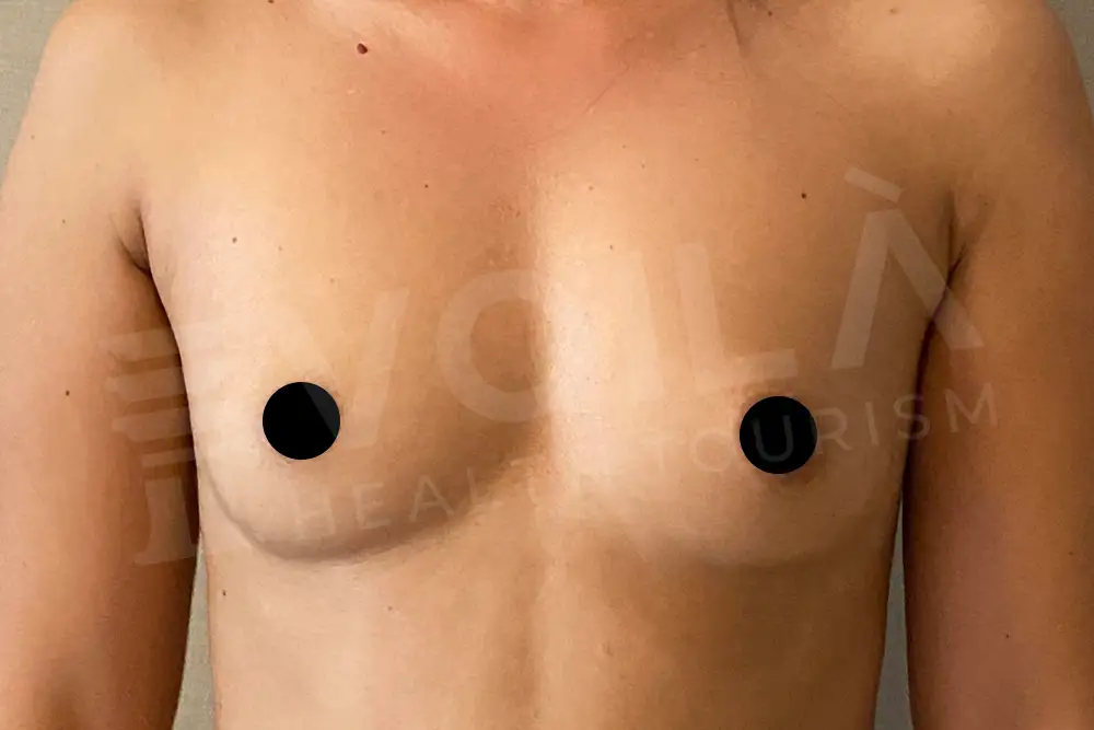 Breast Implant - Voila health tourism - dr furkan certel