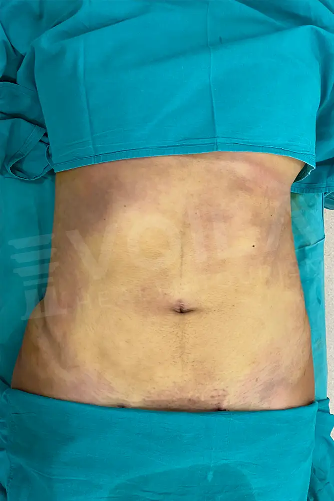 Liposuction - Voila health tourism - dr furkan certel