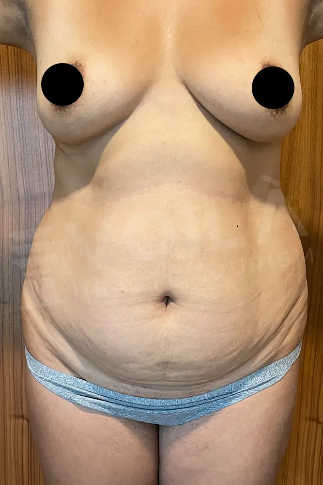 Liposuction - Voila health tourism - dr furkan certel