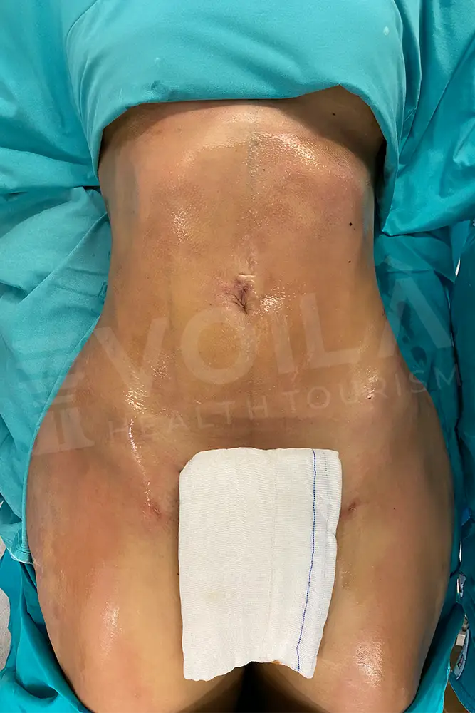 Liposuction - Voila health tourism - dr furkan certel
