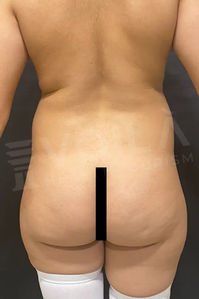 Brazilian Butt Lift - Voila Health Tourism