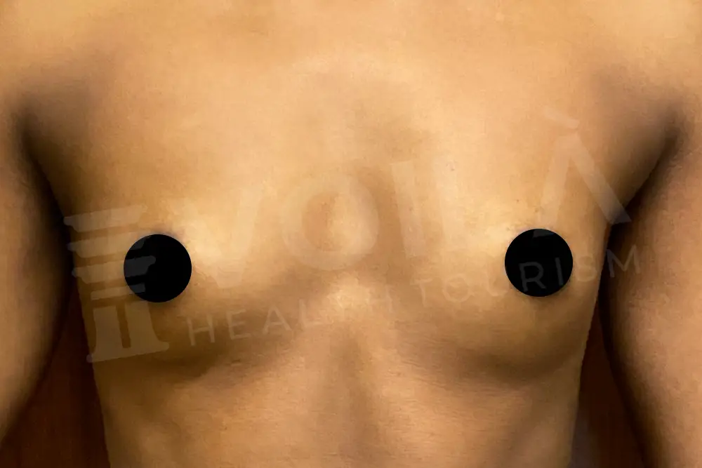 Breast Implant - Voila health tourism - dr furkan certel