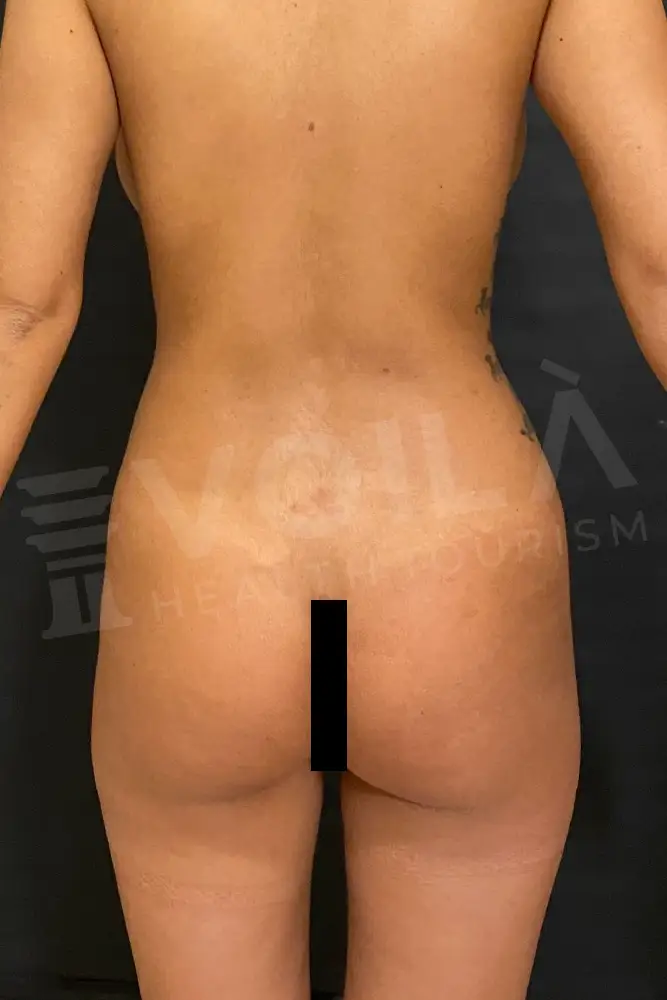 Brazilian Butt Lift - Voila Health Tourism