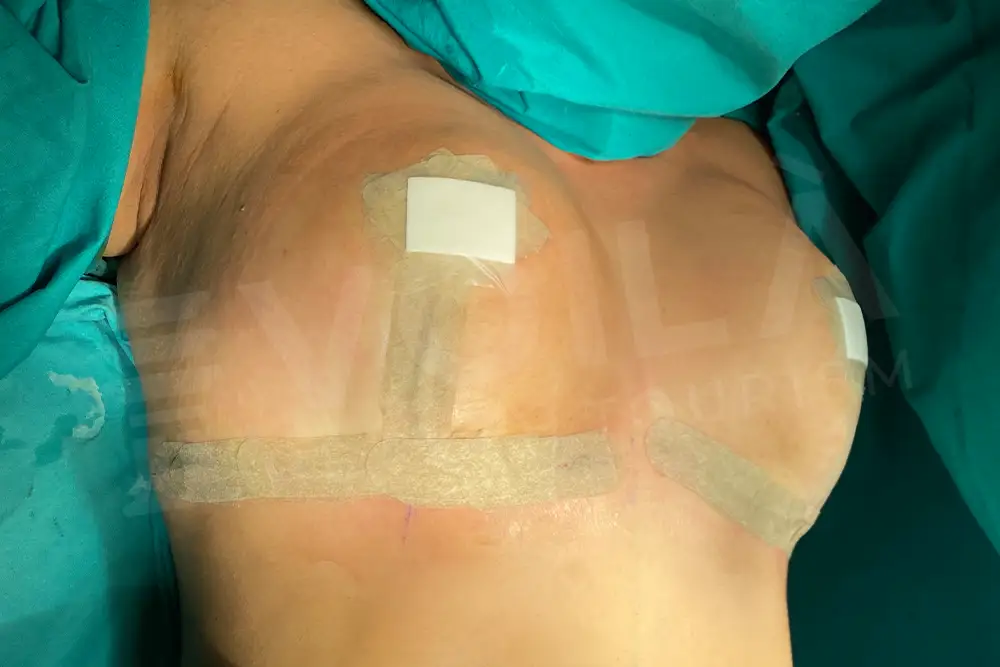Breast Lift - Voila health tourism - dr furkan certel