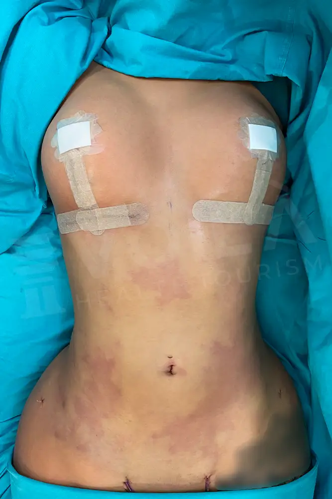 Liposuction - Voila health tourism - dr furkan certel