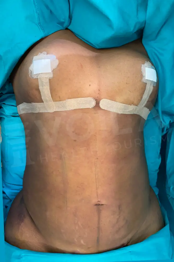 Liposuction - Voila health tourism - dr furkan certel
