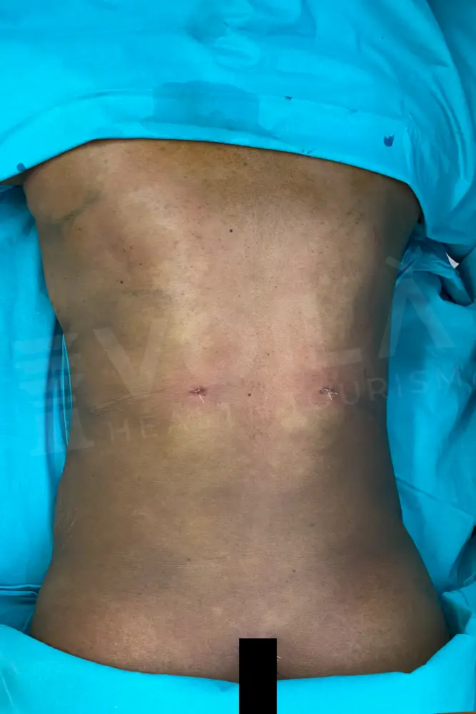 Liposuction - Voila health tourism - dr furkan certel