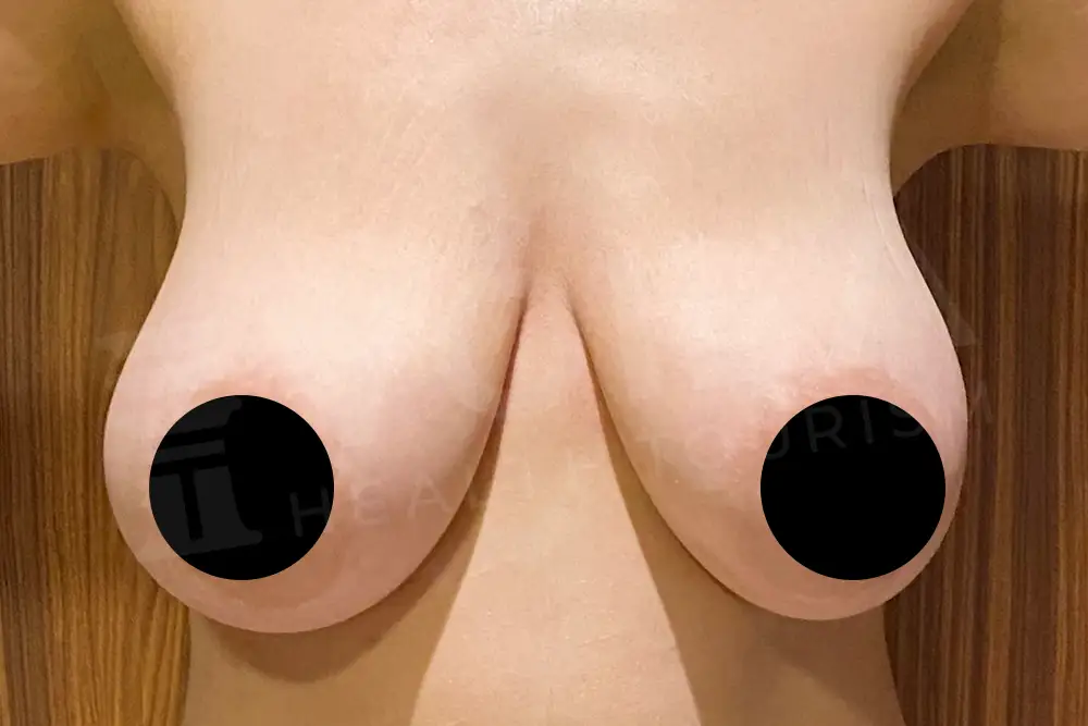 Breast Lift - Voila health tourism - dr furkan certel