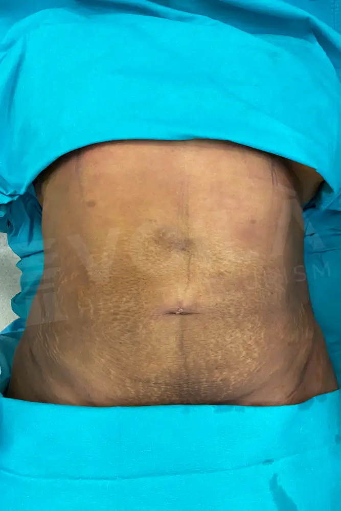 Liposuction - Voila health tourism - dr furkan certel