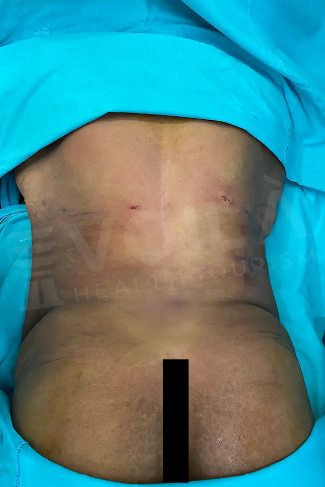 Liposuction - Voila health tourism - dr furkan certel