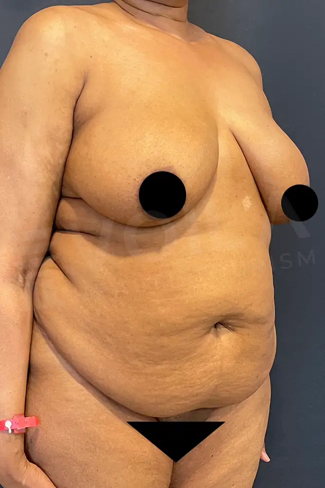 Mommy Makeover - Voila Health Tourism