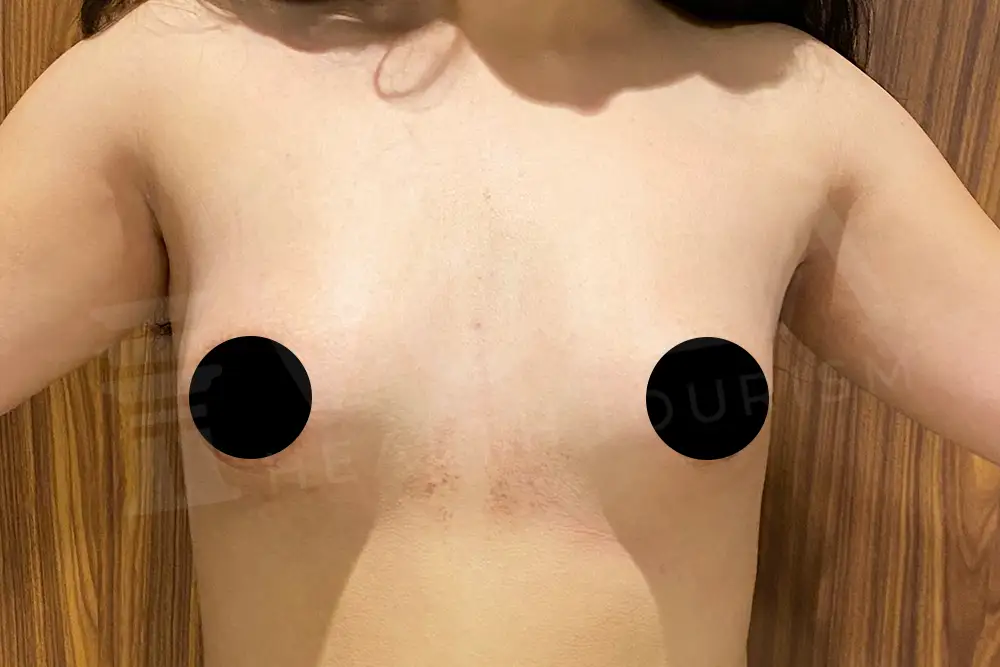 Breast Implant - Voila health tourism - dr furkan certel