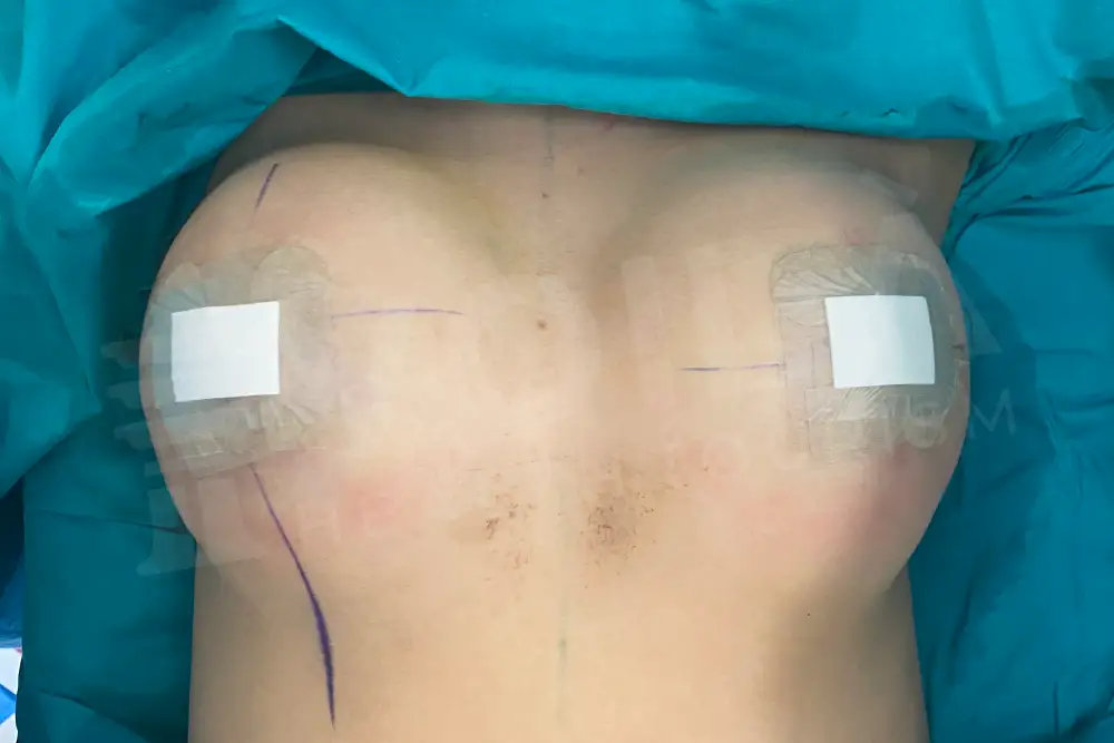 Breast Implant - Voila health tourism - dr furkan certel