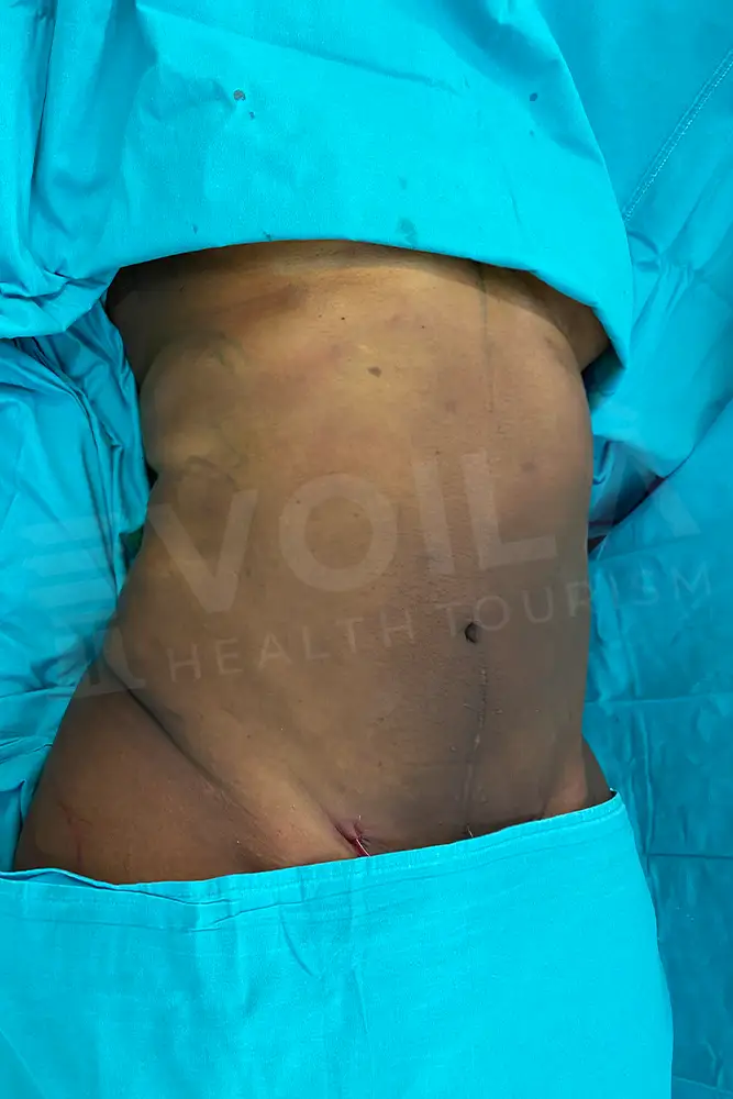 Liposuction - Voila health tourism - dr furkan certel