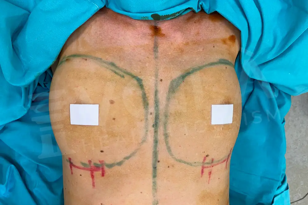 Breast Implant - Voila health tourism - dr furkan certel