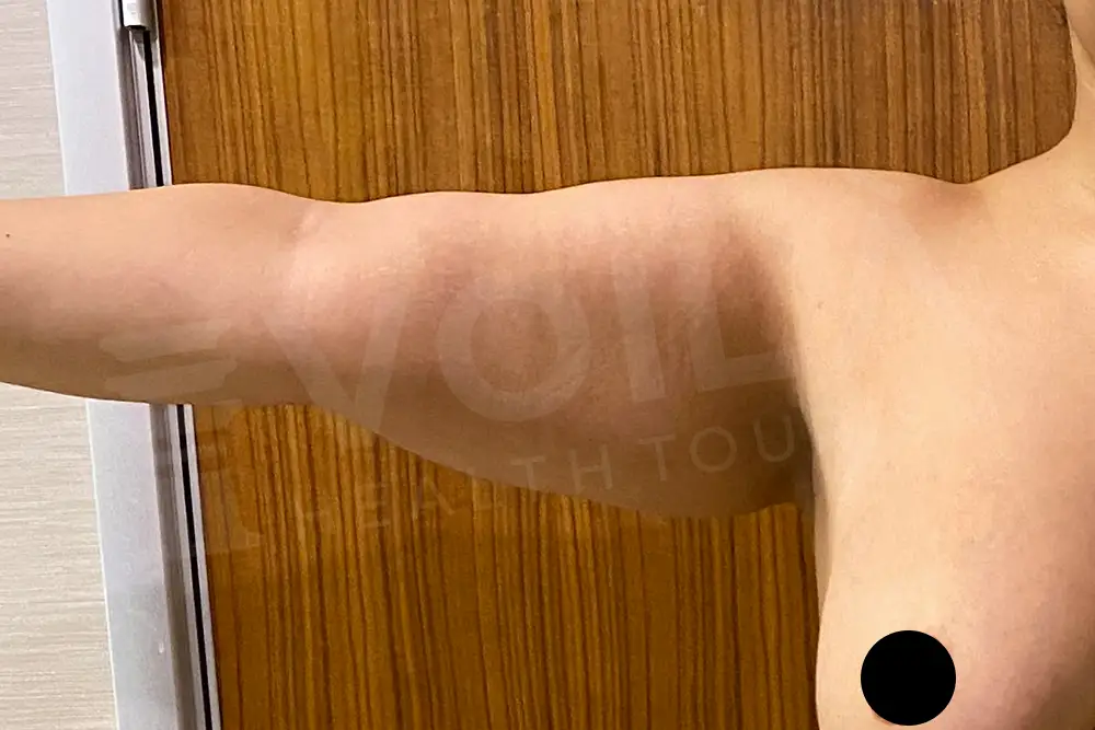 Arm Lift - Voila Health Tourism - Dr Furkan Certel