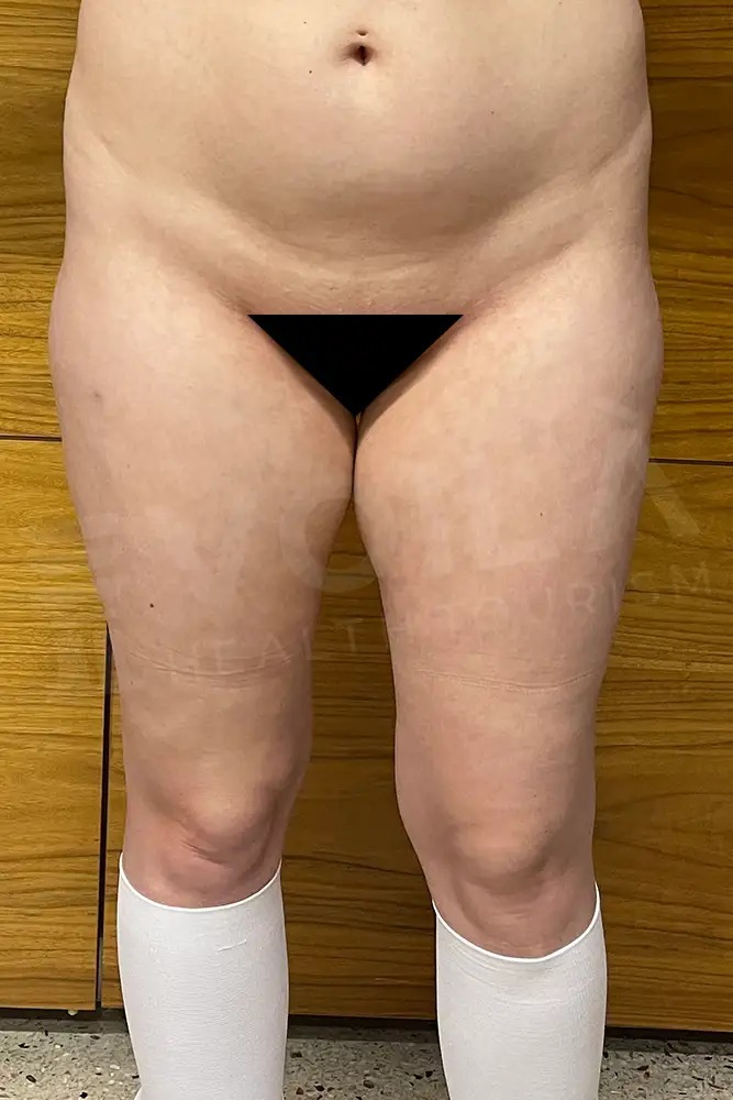 Leg Liposuction - Voila Clinic