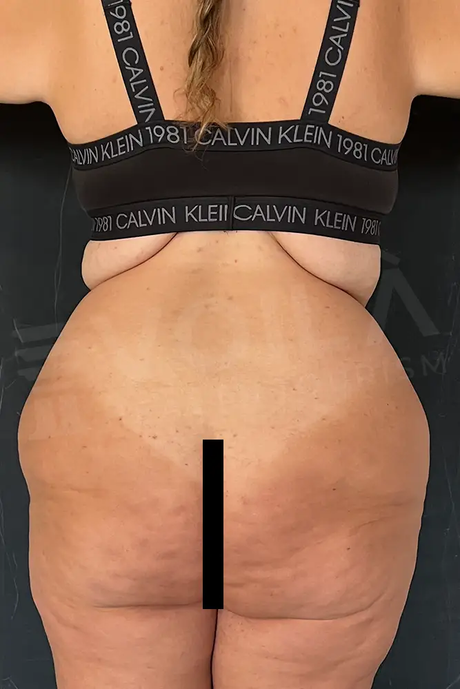 Back Lift - Voila Health Tourism - Dr Furkan Certel