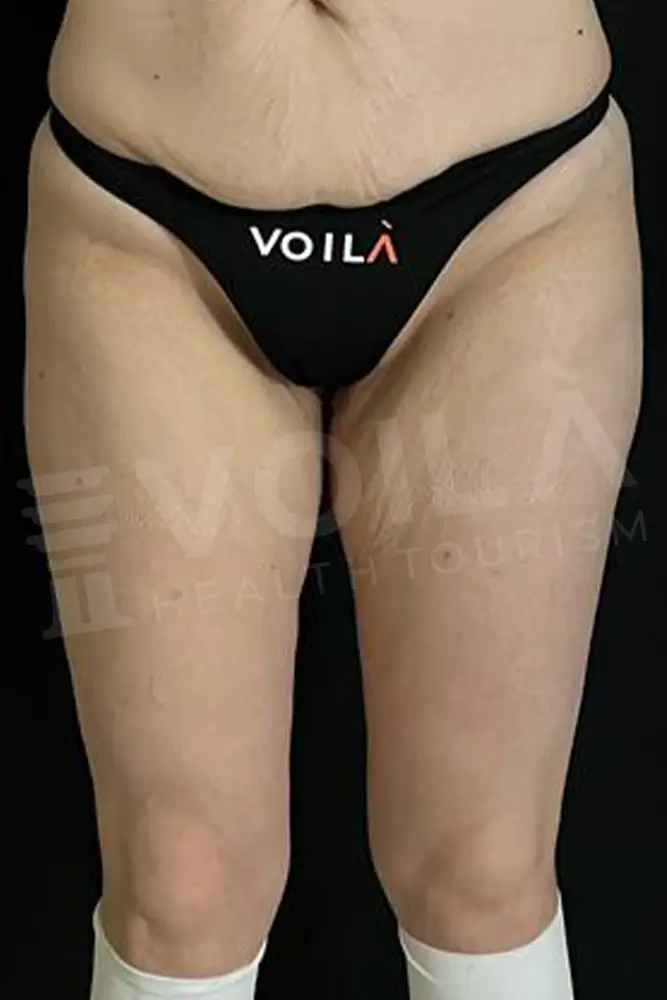 Thigh Lift - Before & After- Vo