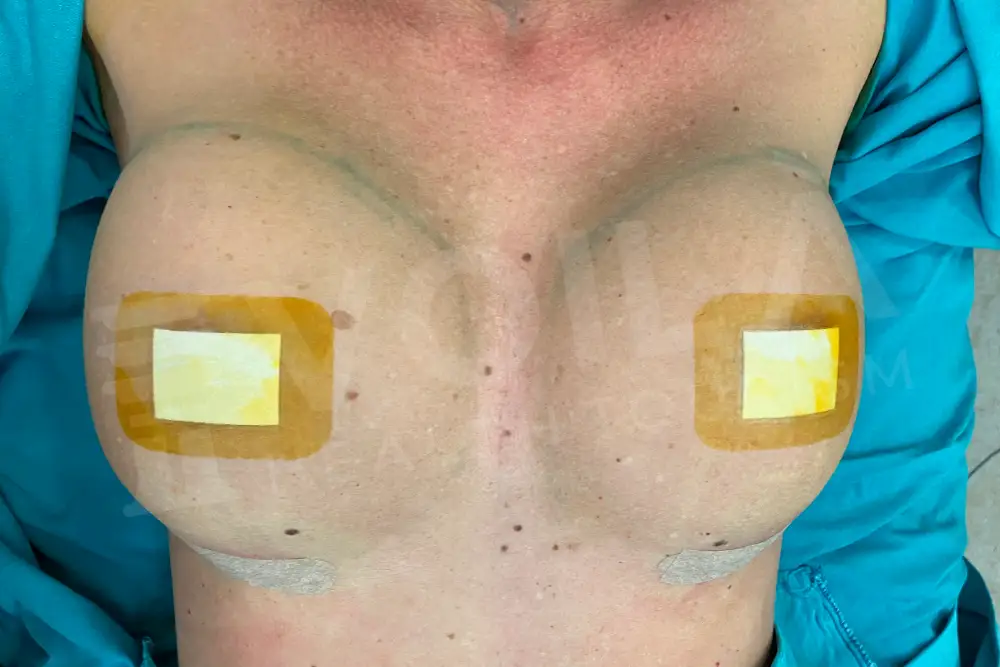 Breast Implant - Voila health tourism - dr furkan certel