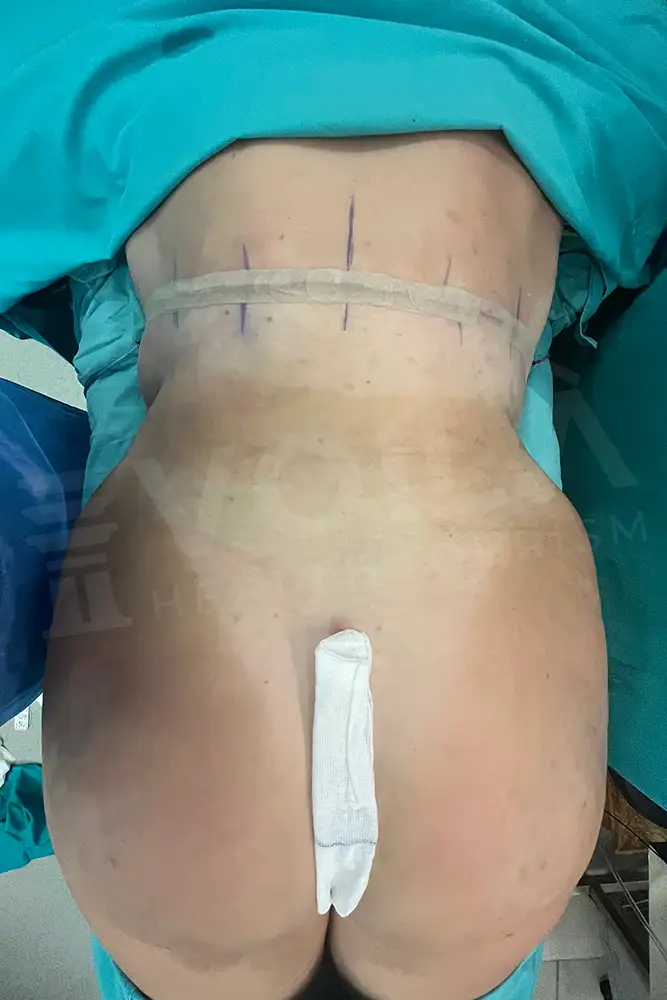 Back Lift - Voila Health Tourism - Dr Furkan Certel