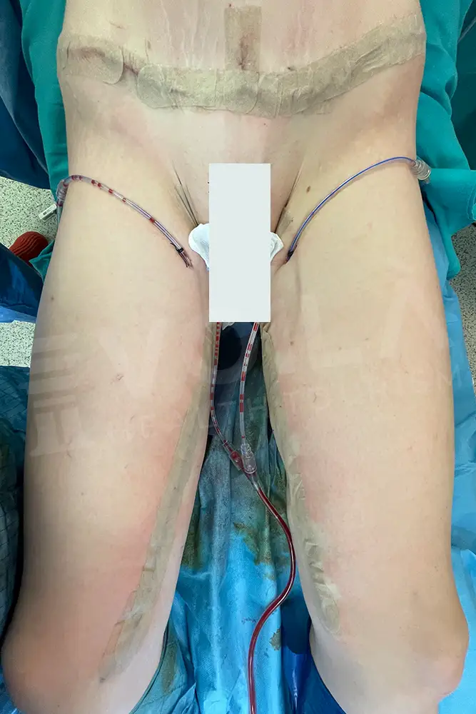 Thigh Lift - Before & After- Vo