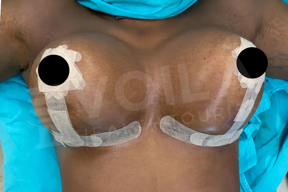 Breast Lift & Implant - Voila Health Tourism - Dr Furkan Certel
