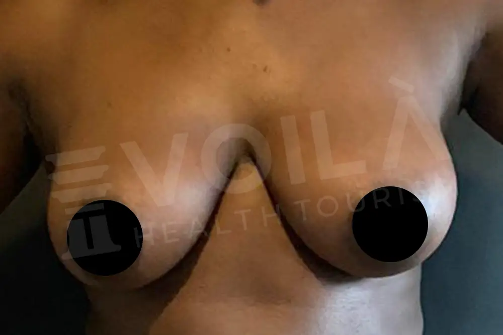 Breast Lift - - Voila health tourism - dr furkan certel