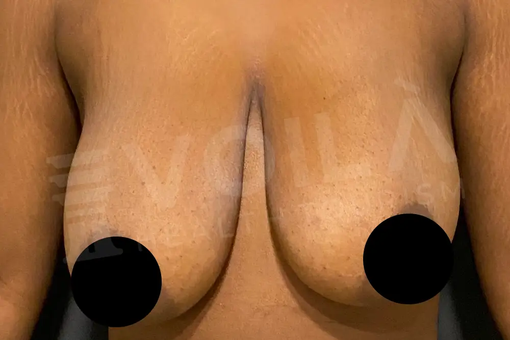 Breast Lift & Implant - Voila Health Tourism - Dr Furkan Certel