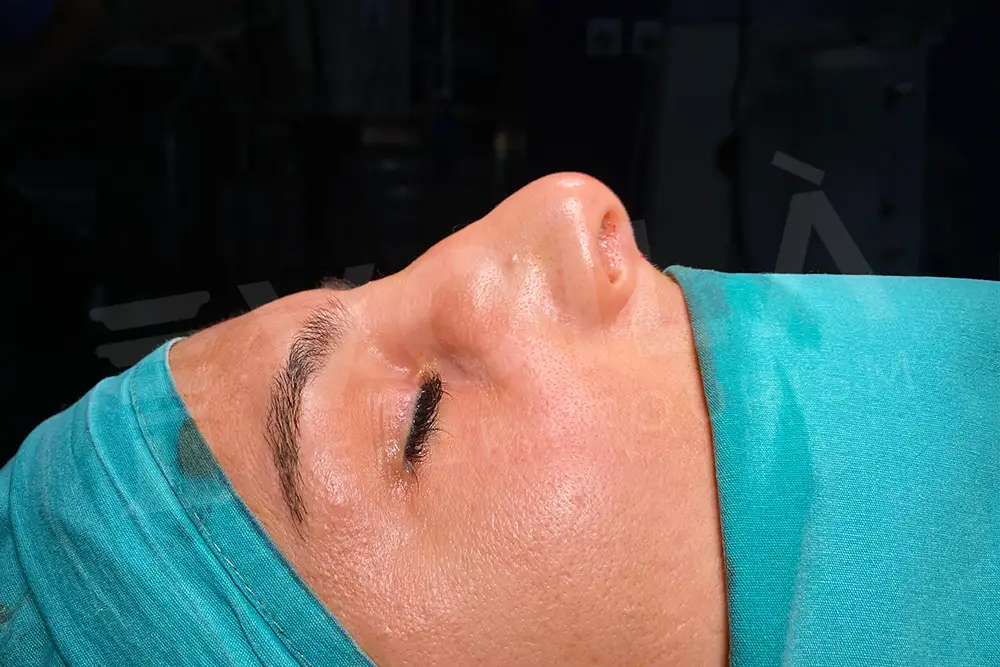 Rinoplasty - Voila health tourism - dr furkan certel