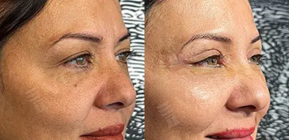 Blepharoplasty- Voila Clinic - Dr Furkan Certel