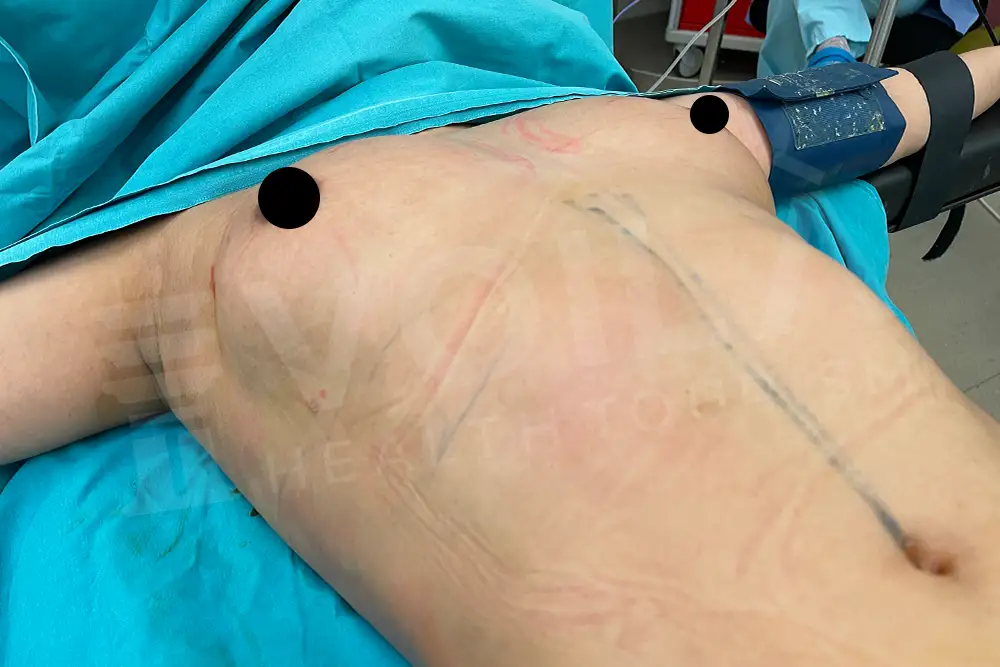 Breast Fat Injection - Voila Clinic - Dr Furkan Certel