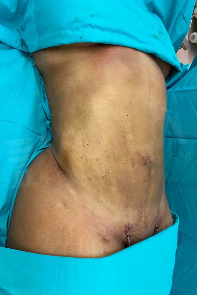 Liposuction - Voila health tourism - dr furkan certel