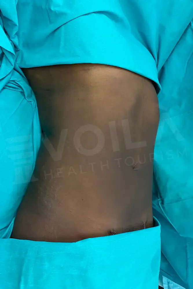 Liposuction - Voila health tourism - dr furkan certel