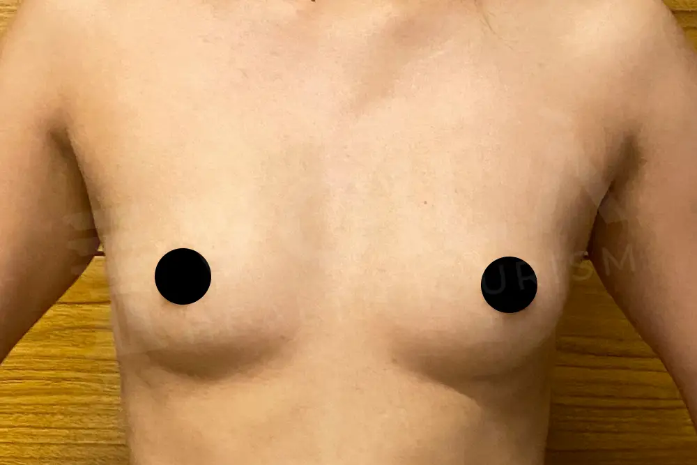 Breast Implant - Voila health tourism - dr furkan certel