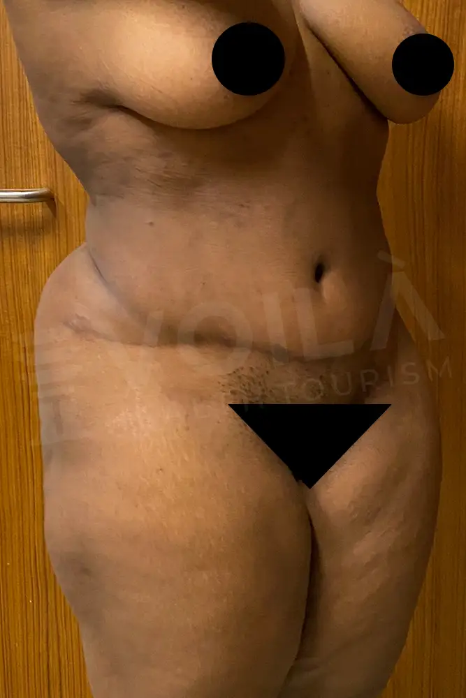 Liposuction - Voila health tourism - dr furkan certel