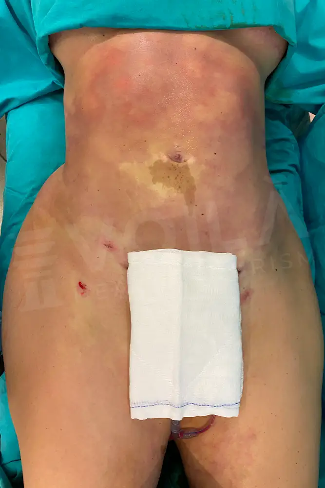Liposuction - Voila health tourism - dr furkan certel
